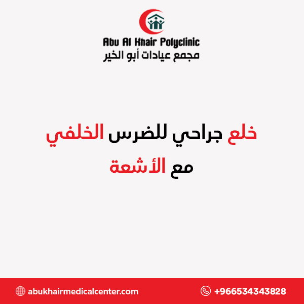 خلع جراحي للضرس الخلفي مع الأشعة service